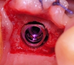 Имплантат V3 от компании MIS Implants Technologies в полости рта. 