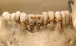 VII в. до н.э. Первый стоматологический мост