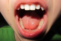На этой фотографии «до» операции видно, что уздечка крепится практически к самому кончику языка – нет возможности поднять язык к верхним зубам и, вообще, хоть сколько-нибудь приподнять его к верху. 